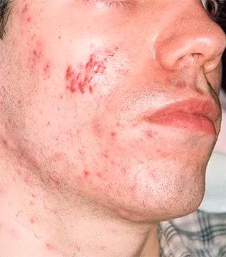 Rostro de un hombre con acné y un grupo de lesiones rojas en la mejilla.