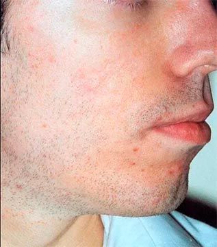 Perfil lateral de un hombre con piel rojiza y pequeñas protuberancias rojas en la cara y el cuello.