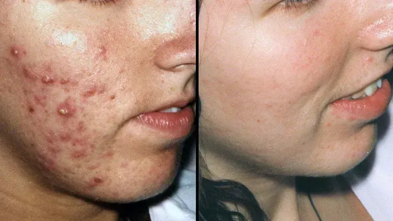 Una fotografía de antes y después de la cara de una mujer con acné.