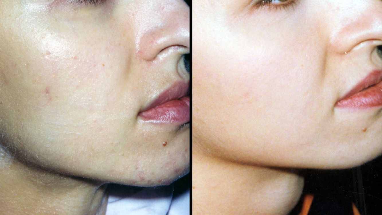 Una fotografía de antes y después del rostro de una mujer.