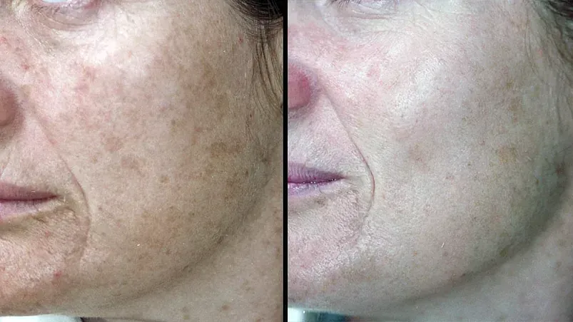 Una fotografía de antes y después del rostro de una mujer.