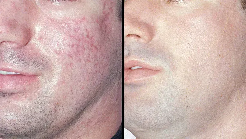Una foto de antes y después de la cara de un hombre con acné.