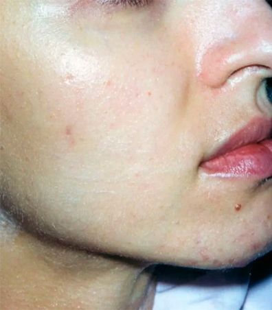 Primer plano del rostro de una persona que muestra la piel enrojecida, con pequeñas protuberancias y algo húmeda. Se aprecian la nariz, los labios y el mentón.