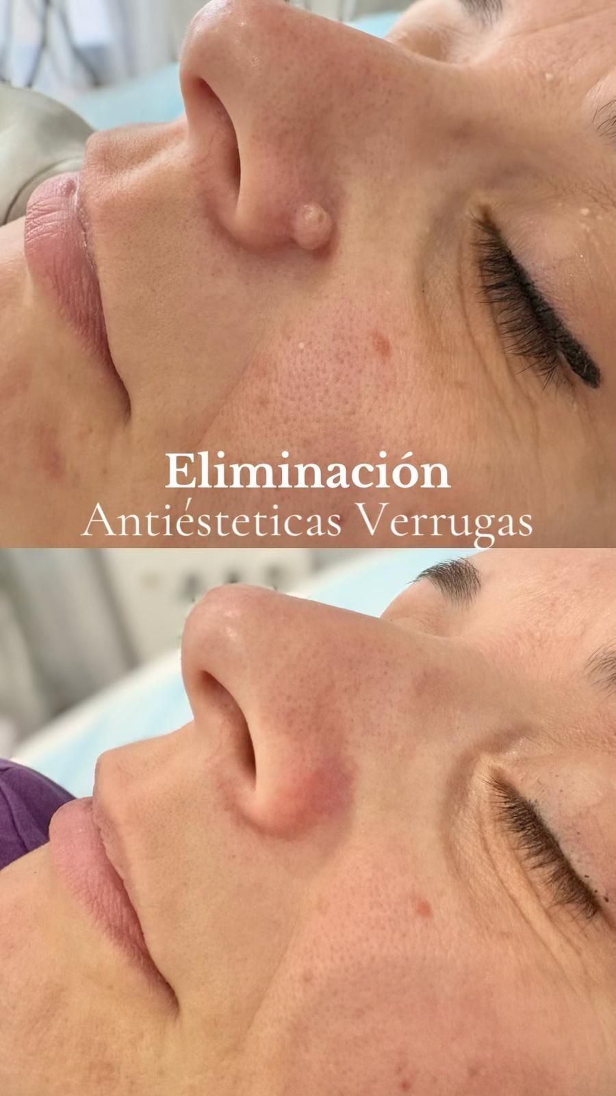 Comparación del antes y el después de una lesión cutánea facial extirpada del lateral de la nariz.