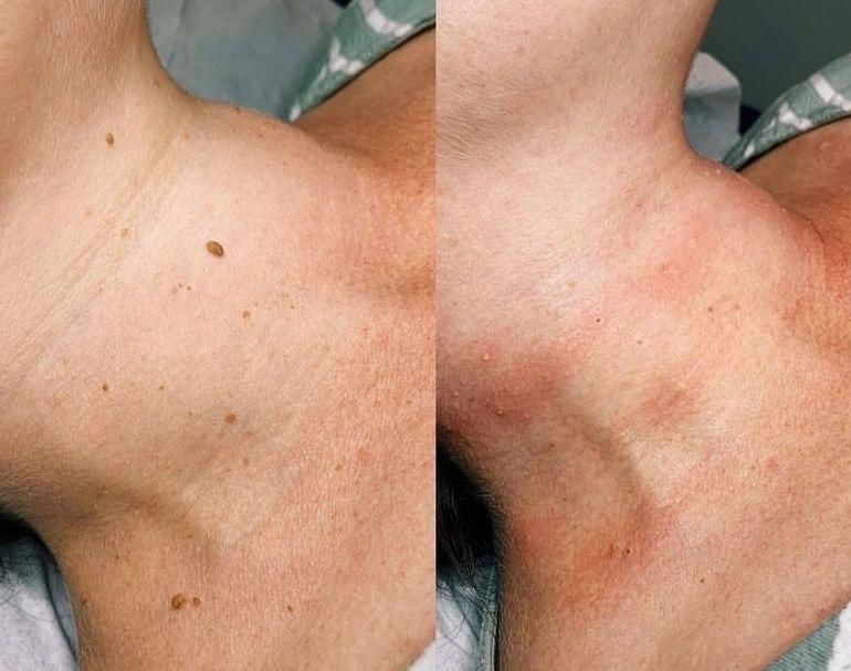 Comparación de la piel del cuello antes y después de la eliminación de varias pequeñas verrugas cutáneas.