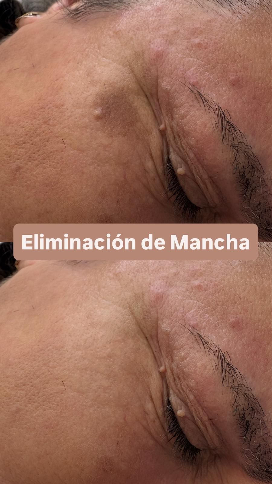 Comparación del antes y el después de una zona de la piel del rostro que muestra la eliminación
