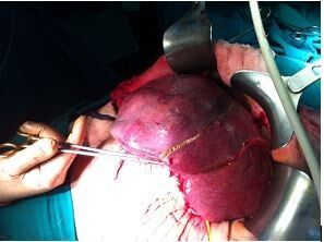 Ευμεγέθης Ηπατοκυτταρικός Καρκίνος (20cm) στο δεξιό λοβό του ήπατος