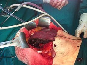 Δεξιά Hπατεκτομή