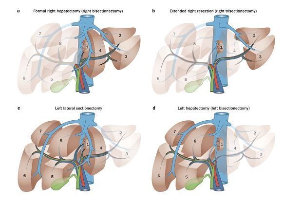 Ηπατεκτομή - Δημήτριος Ε. Γιακουστίδης Χειρουργός