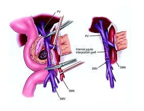 Επέμβαση Whipple