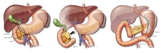 Επέμβαση Whipple