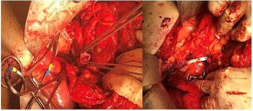 Επέμβαση Whipple για καρκίνο κεφαλής παγκρέατος που διηθούσε την Άνω Μεσεντέριο Φλέβα. Εκτομή και αντικατάσταση της ΑΜΦ με αγγειακό μόσχευμα PTFE