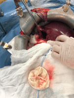 Εχινόκοκκος Κύστη