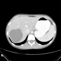 Εχινόκοκκος Κύστη