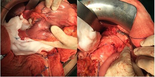 Λεμφαδενικός καθαρισμός D2 σε δύο διαφορετικούς ασθενείς