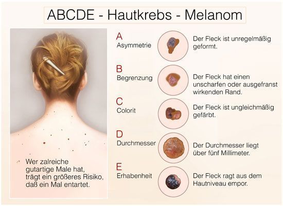 ABCDE-Methode bei Hautkrebserkennung
