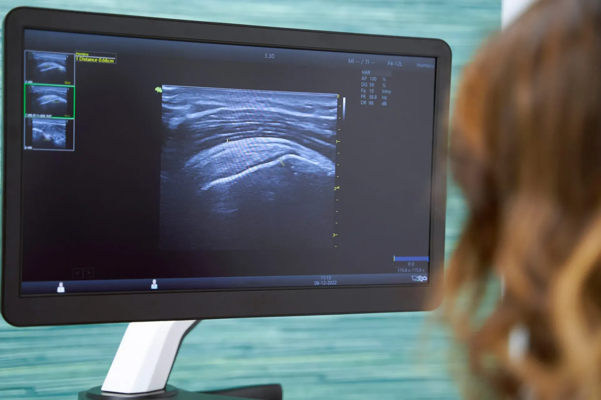 Una persona observa un monitor médico que muestra una imagen ecográfica musculoesquelética de un hombro o una articulación.