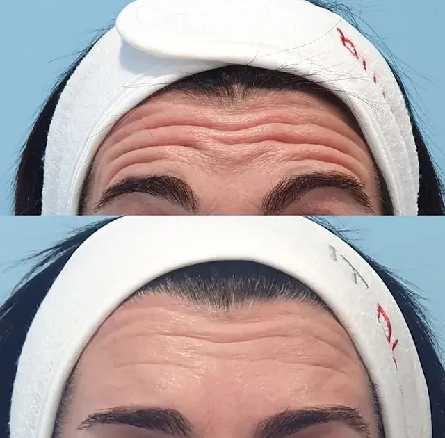 Una foto de antes y después de la frente de una mujer.