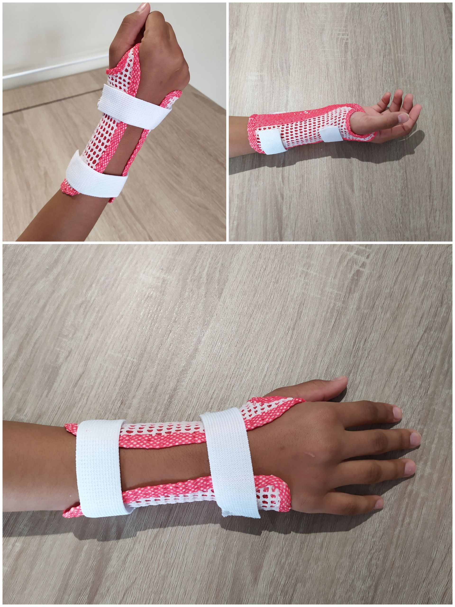 Orthèse thermoformée rouge et blanche pour le poignet