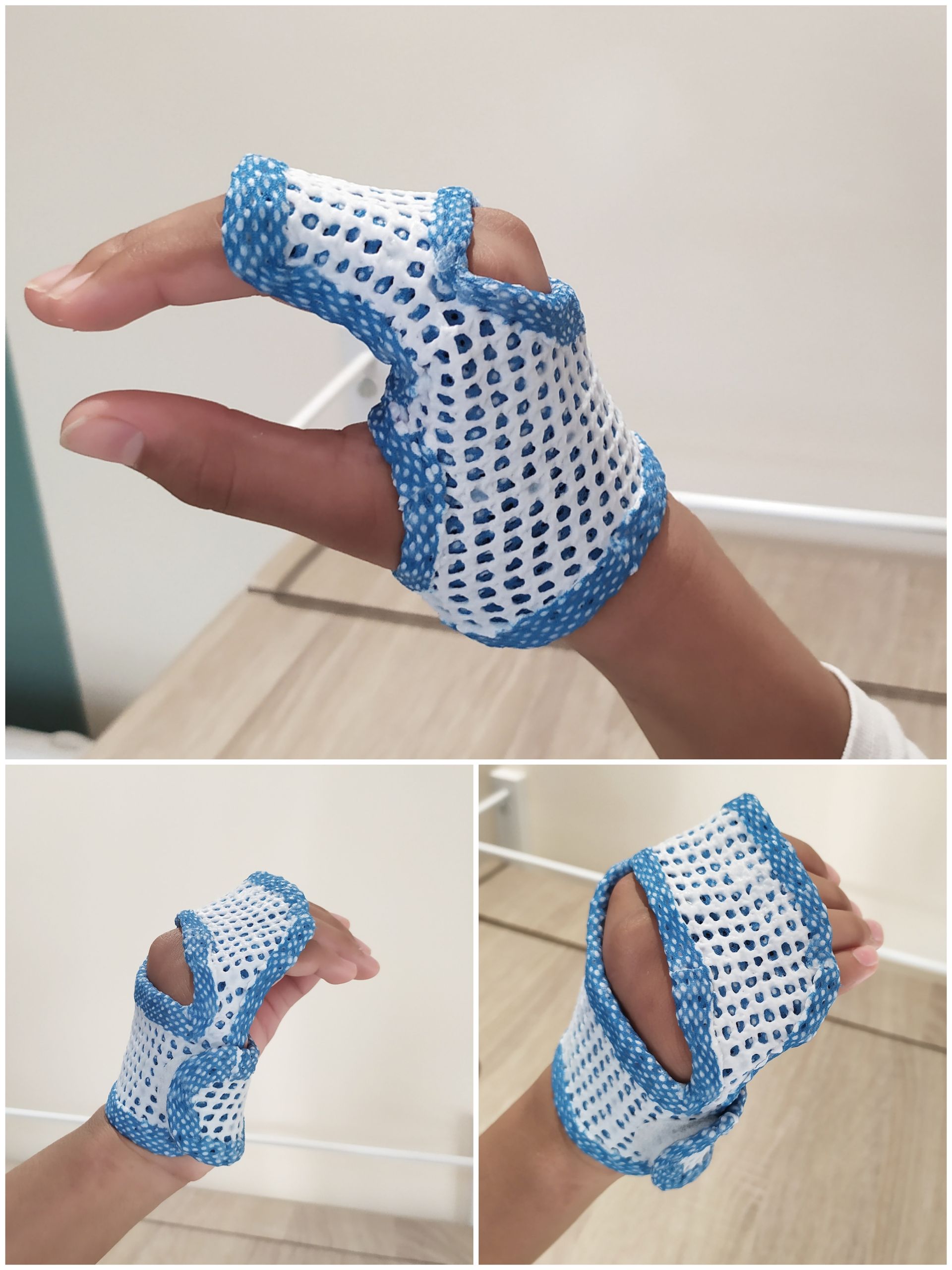Orthèse thermoformée bleue et blanche pour l'articulation des doigts