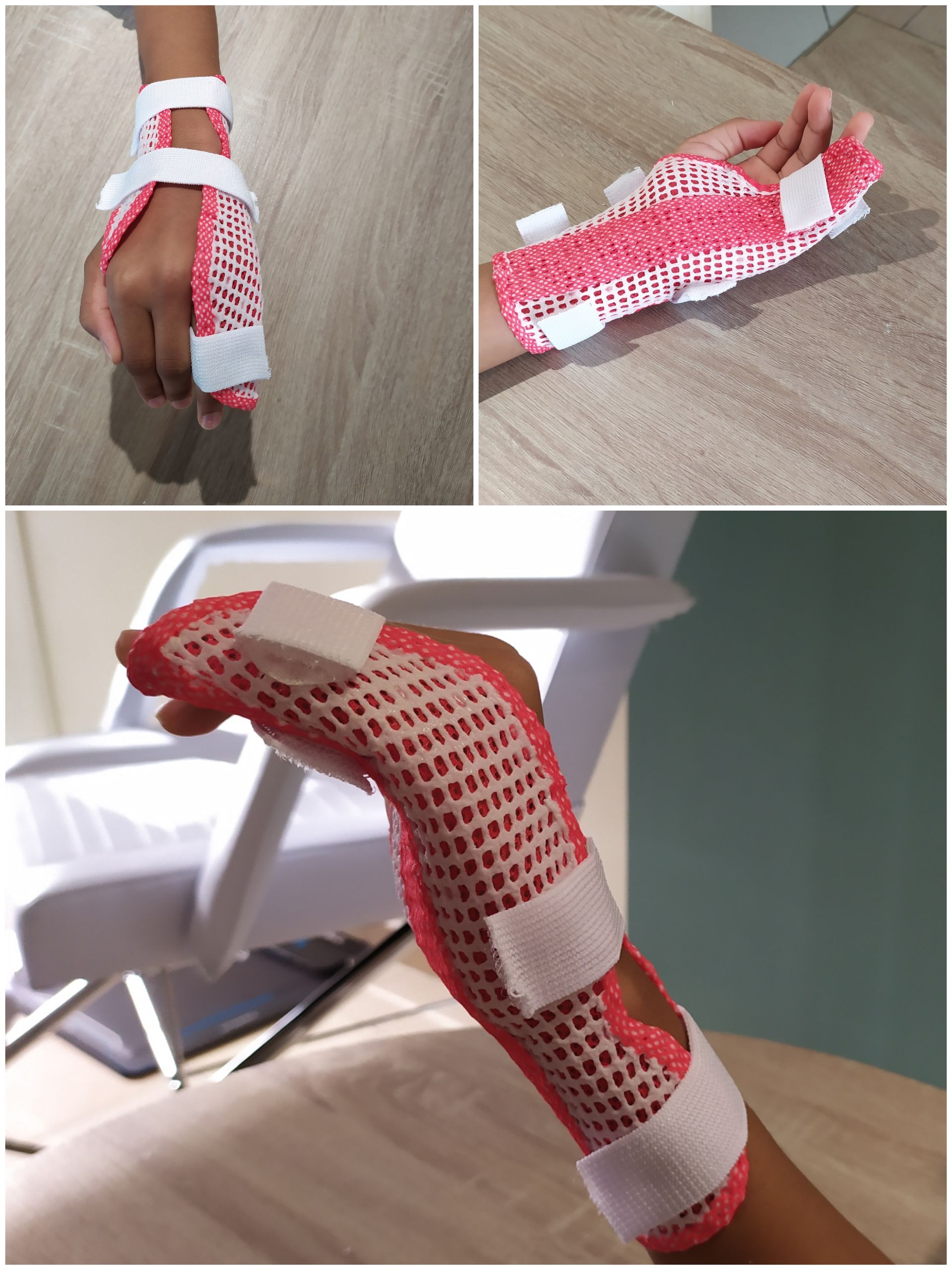 Orthèse thermoformée blanche et rouge pour le poignet et la main