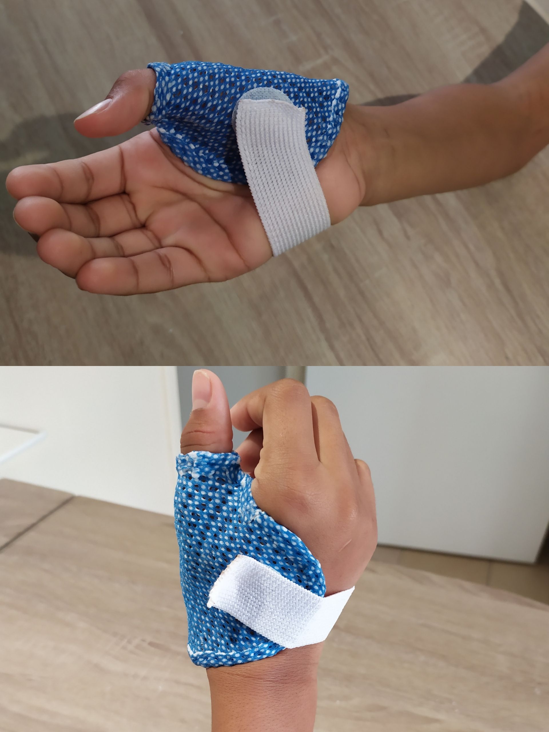 Orthèse thermoformée bleue pour le pouce