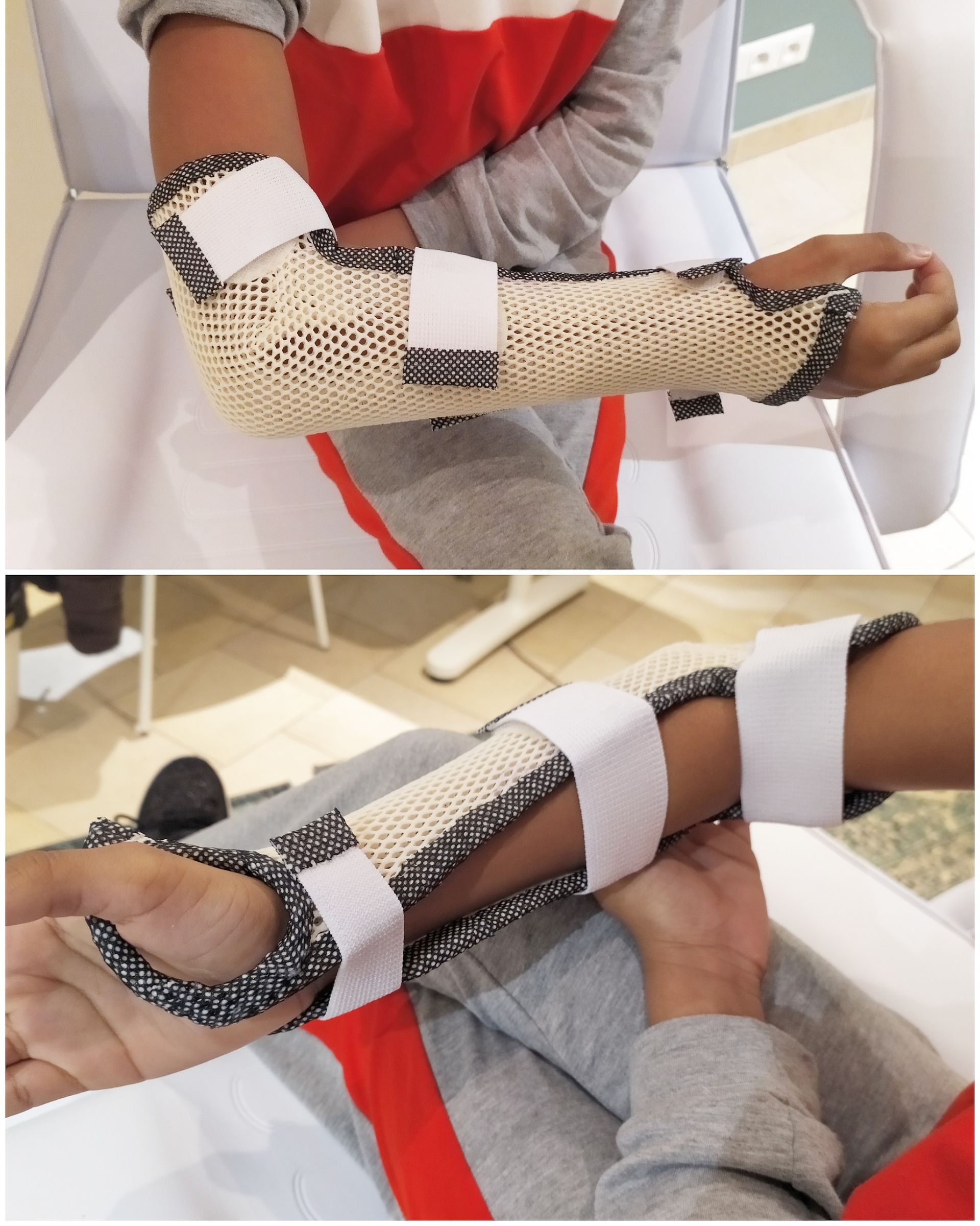 Orthèse thermoformée noire et blanche pour le coude et le bras