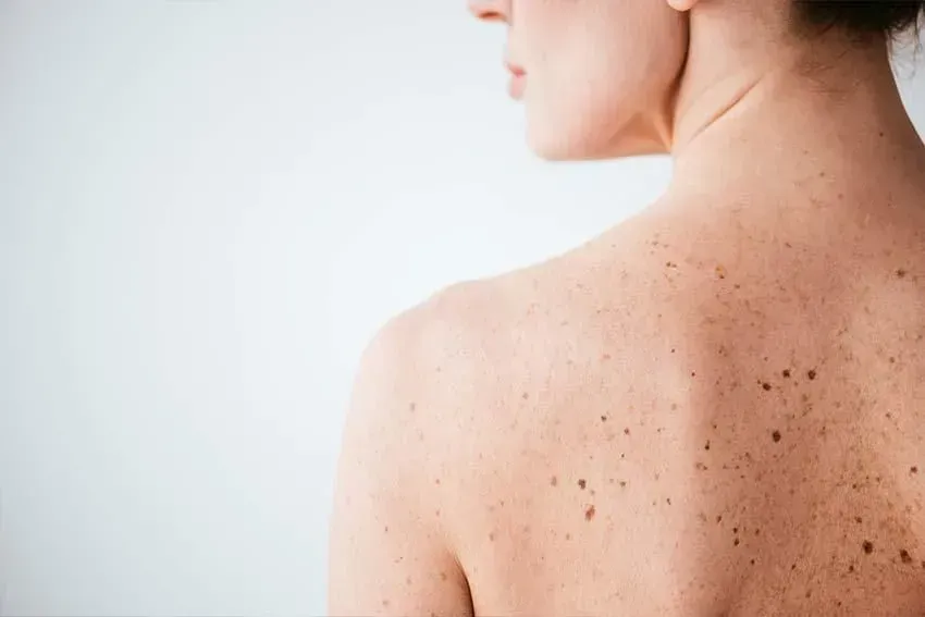 Der Rücken einer Frau mit vielen Sommersprossen. Dermatologie & Ästhetik | Dr. med. Kerstin Schatton