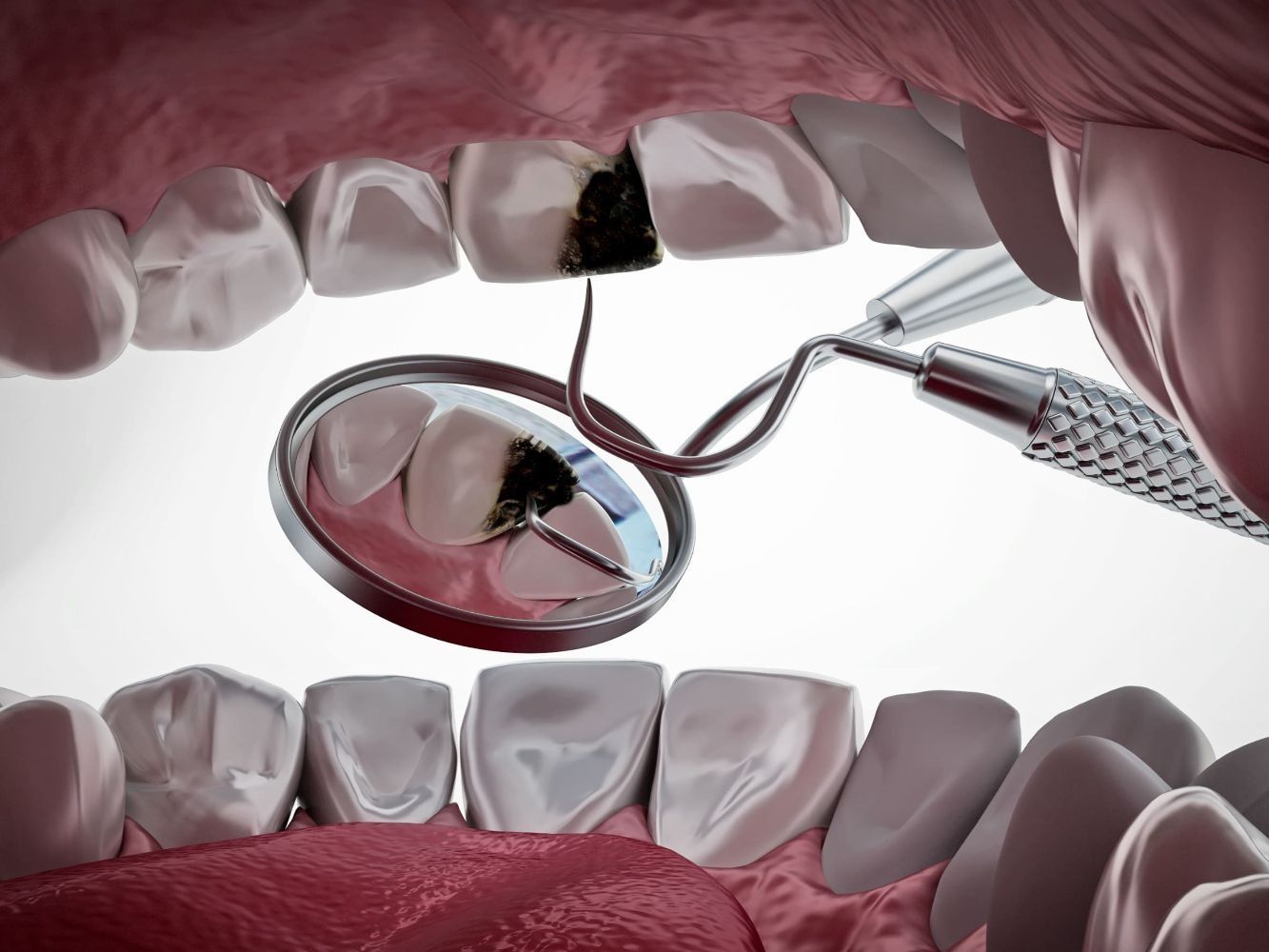 Un dentista está examinando los dientes de una persona con un espejo.