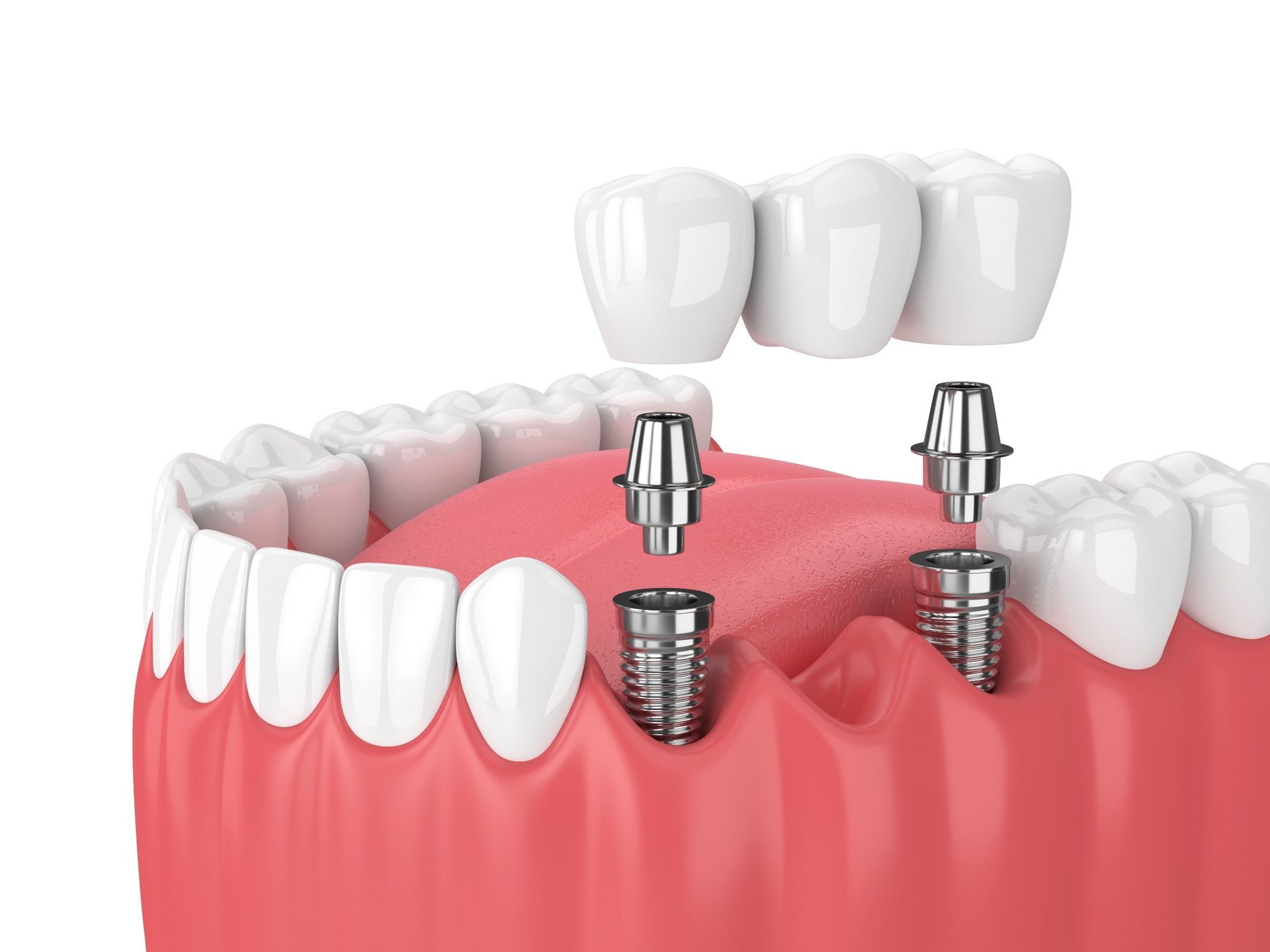 Una representación 3D de un puente dental con implantes dentales.