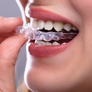 Una mujer se está colocando un aparato transparente en los dientes.