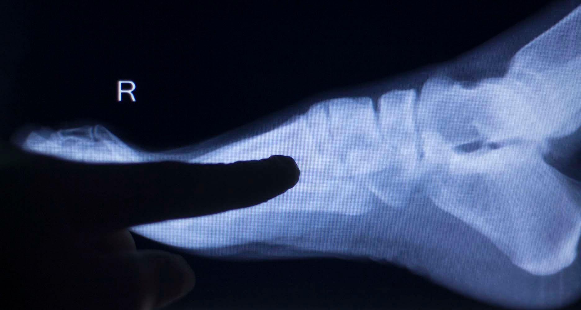 Una persona señala una radiografía de un pie.