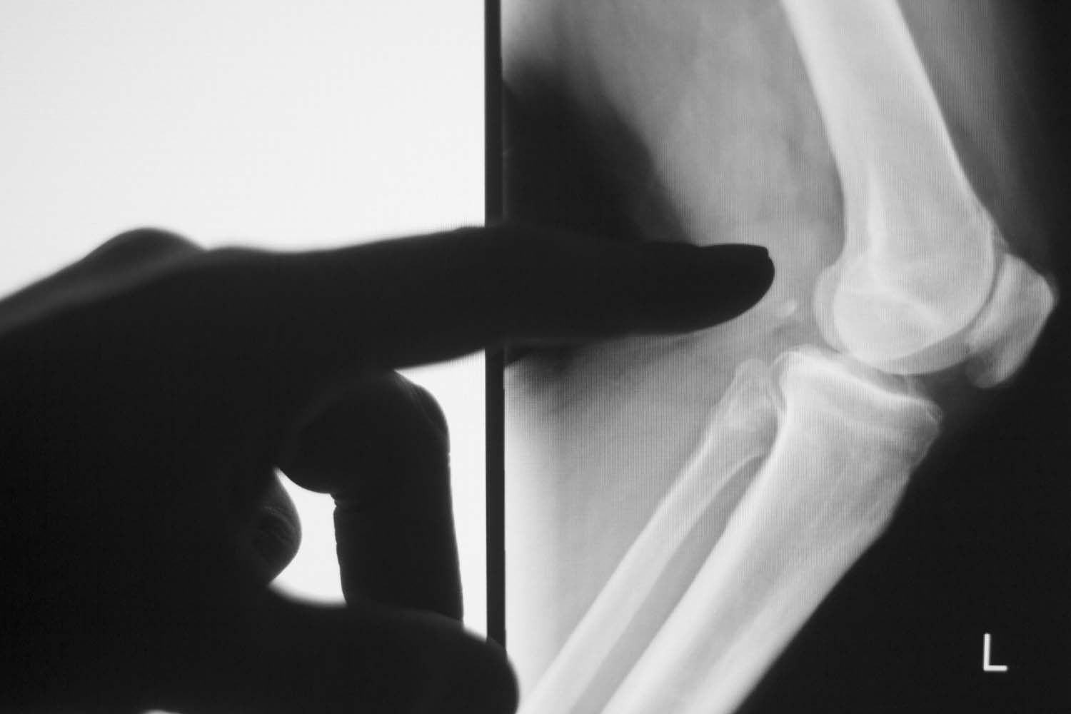 Una persona señala una radiografía de una rodilla.