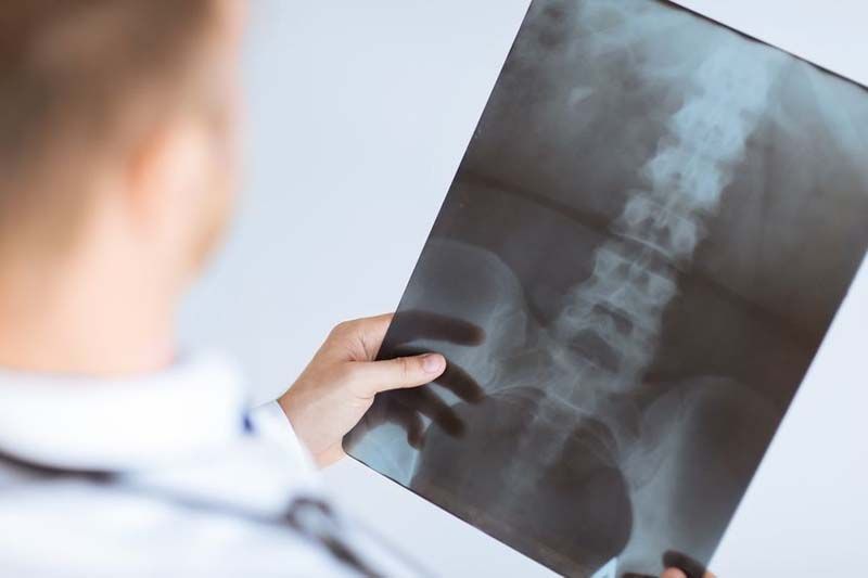 Un médico sostiene una radiografía de la columna vertebral de una persona.