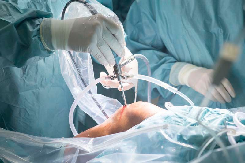 Un cirujano está operando la rodilla de un paciente en un quirófano.