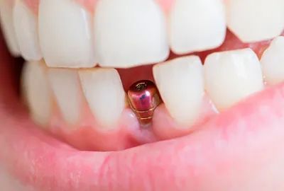 Primer plano de la boca con un implante dental visible entre los dientes; encías rosadas, dientes blancos.