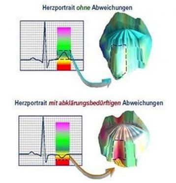 A diagram of a heart with the words herzportrait ohne abweichungen