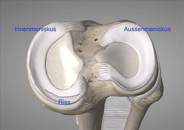 Meniskusriss Behandlung ohne OP