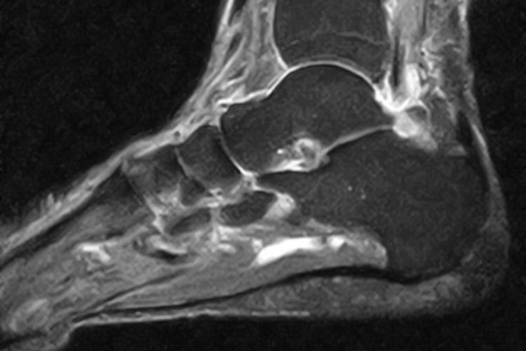 MRT einer vollständig verheilten Plantarsehne 6 Jahre nach Refixation mit Fibrinkleber und ACS-Injektionen in unserer Orthopädie Privatpraxis in Köln.