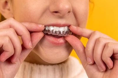 Primer plano de un niño ajustándose un retenedor dental transparente con ambas manos.