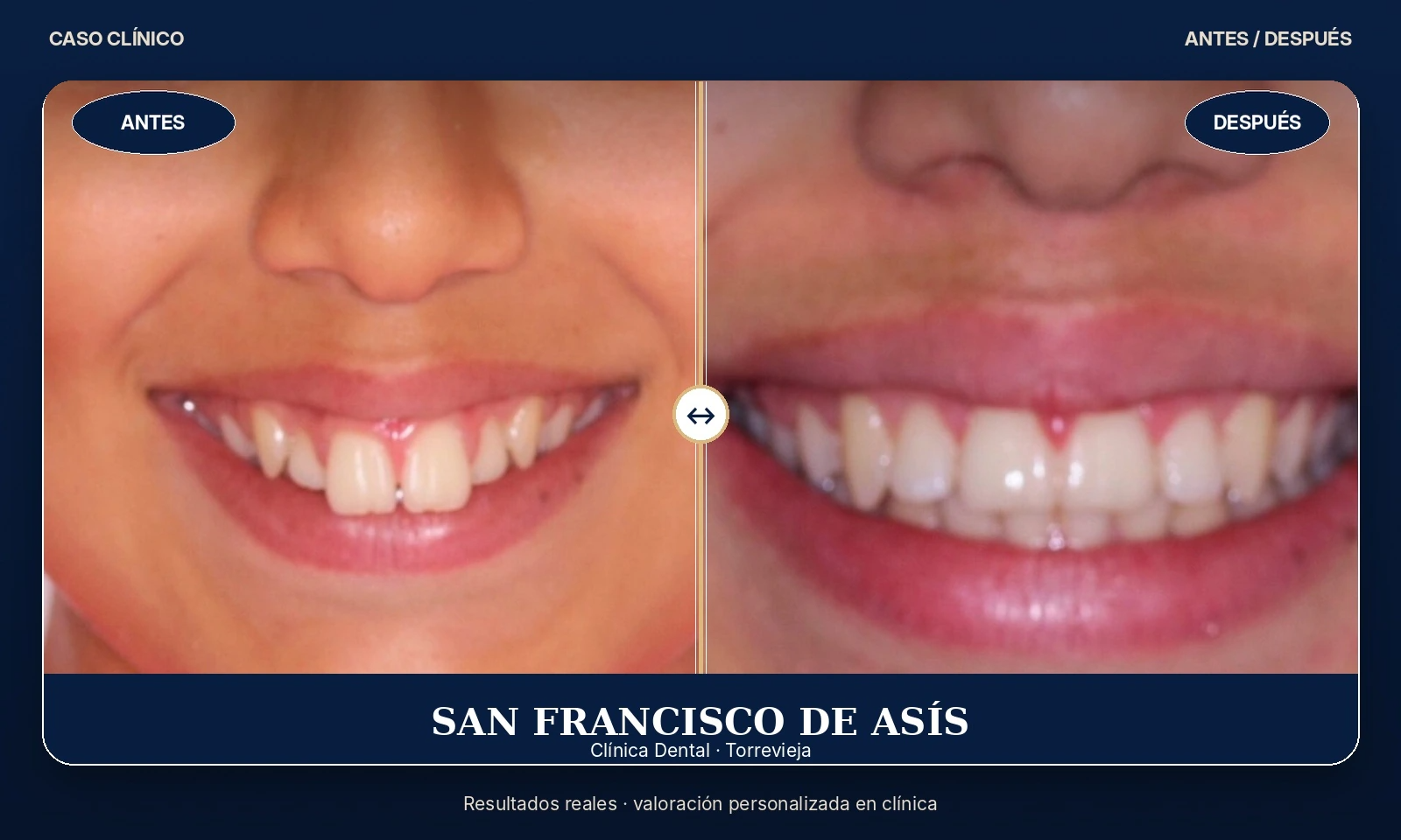 Primer plano comparativo del antes y el después de una boca sonriente con una alineación mejorada de los dientes frontales.