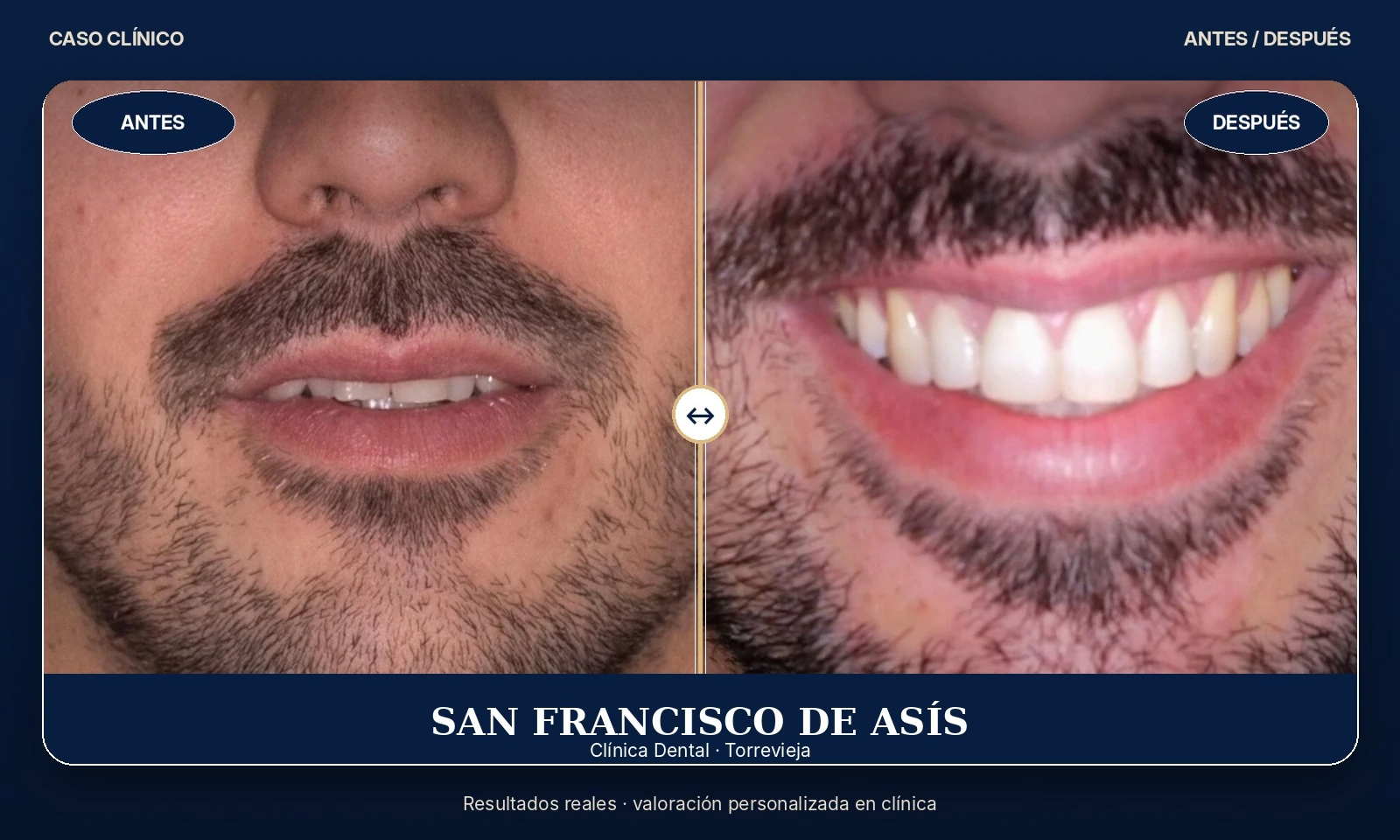 Primer plano de los dientes y la sonrisa de un hombre, antes y después del tratamiento, que muestra una mejora en el blanqueamiento y la alineación.
