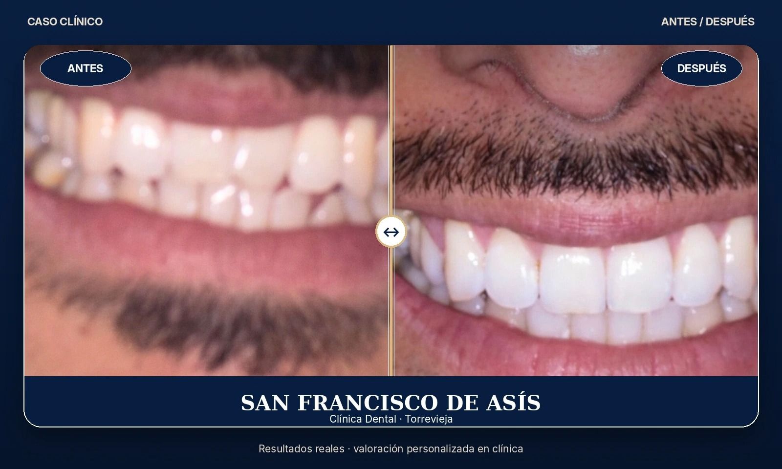 Primer plano del antes y el después del blanqueamiento dental, que muestra los dientes del lado derecho más blancos y brillantes.