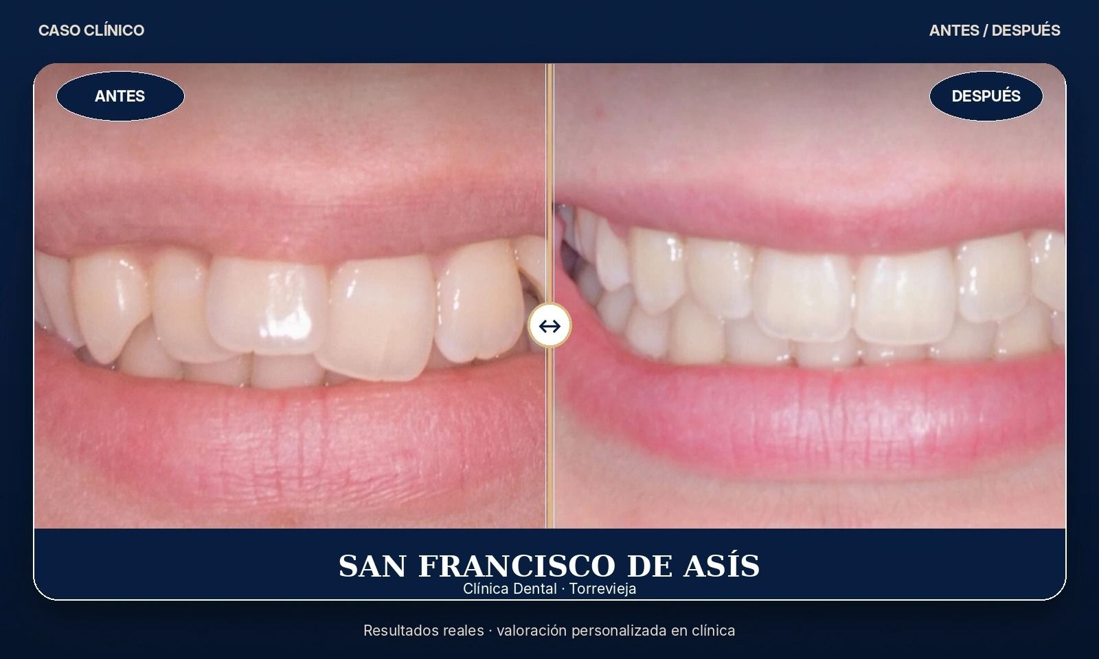Primer plano del antes y el después del blanqueamiento dental, con los dientes más blancos a la derecha.