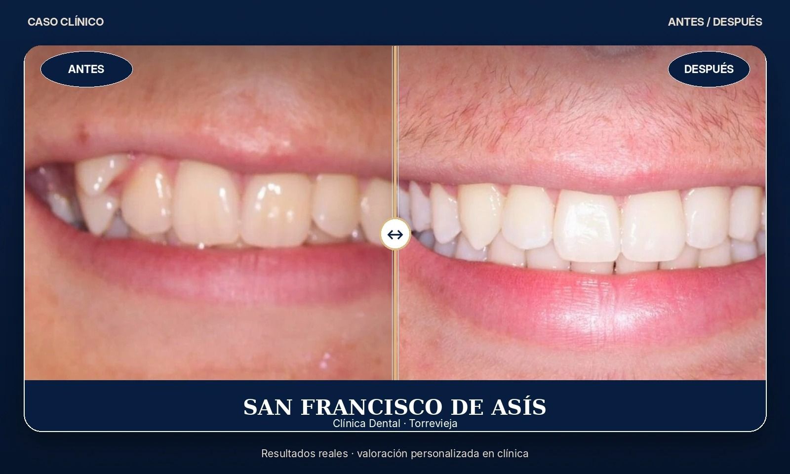 Primer plano del antes y el después del blanqueamiento dental, que muestra dientes más brillantes y blancos en el lado derecho.