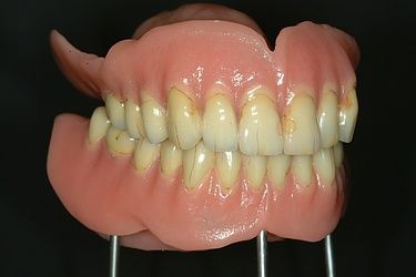 Prothèse dentaire - Laboratoire dentaire Michel Di Mantino - Neuchâtel