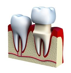 Couronne dentaire - Laboratoire Dentaire Michel Di Mantino - Neuchâtel