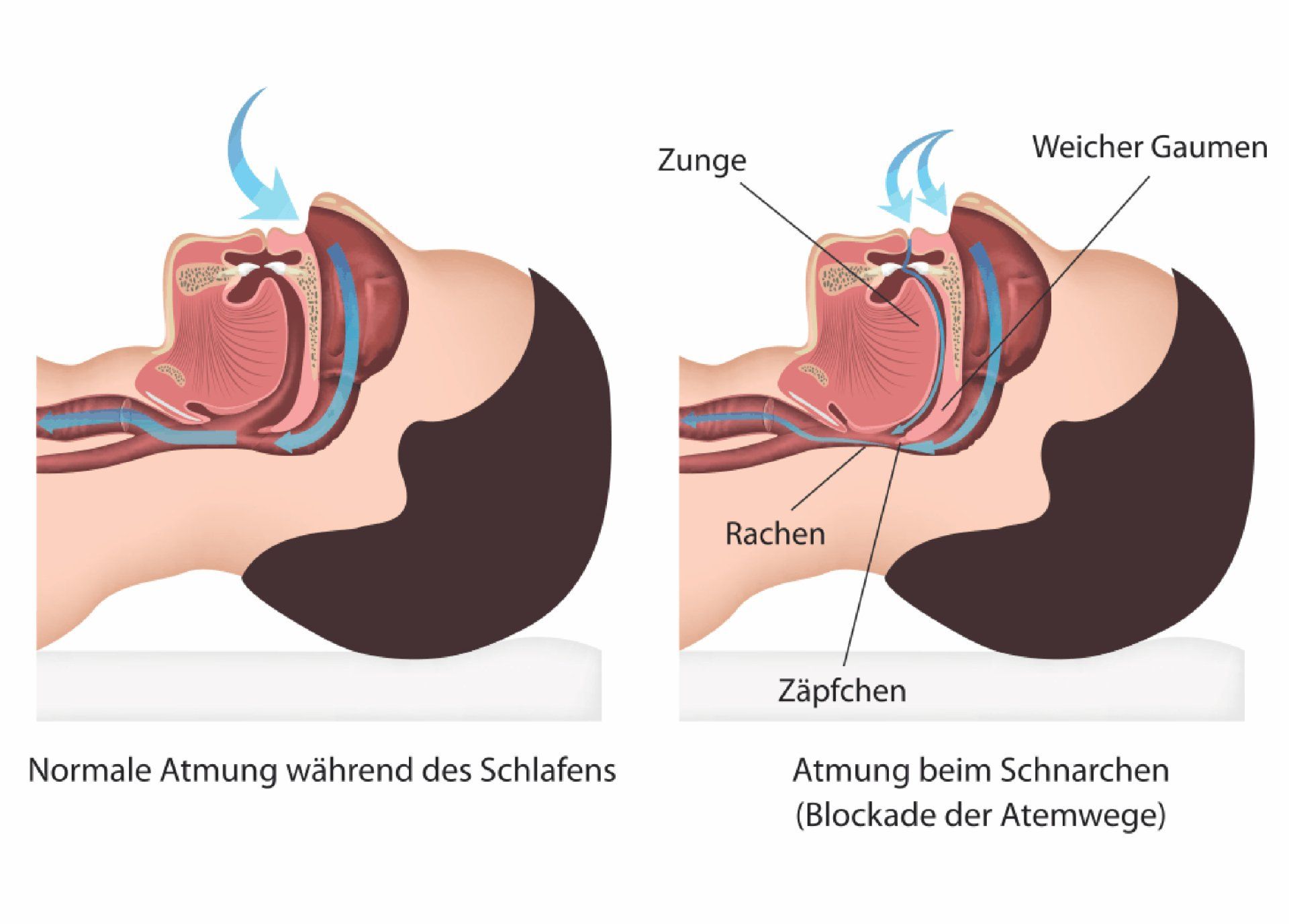 Wie entsteht schnarchen - Kieferorthopädie Dr. med. dent. Jörg Seiferth
