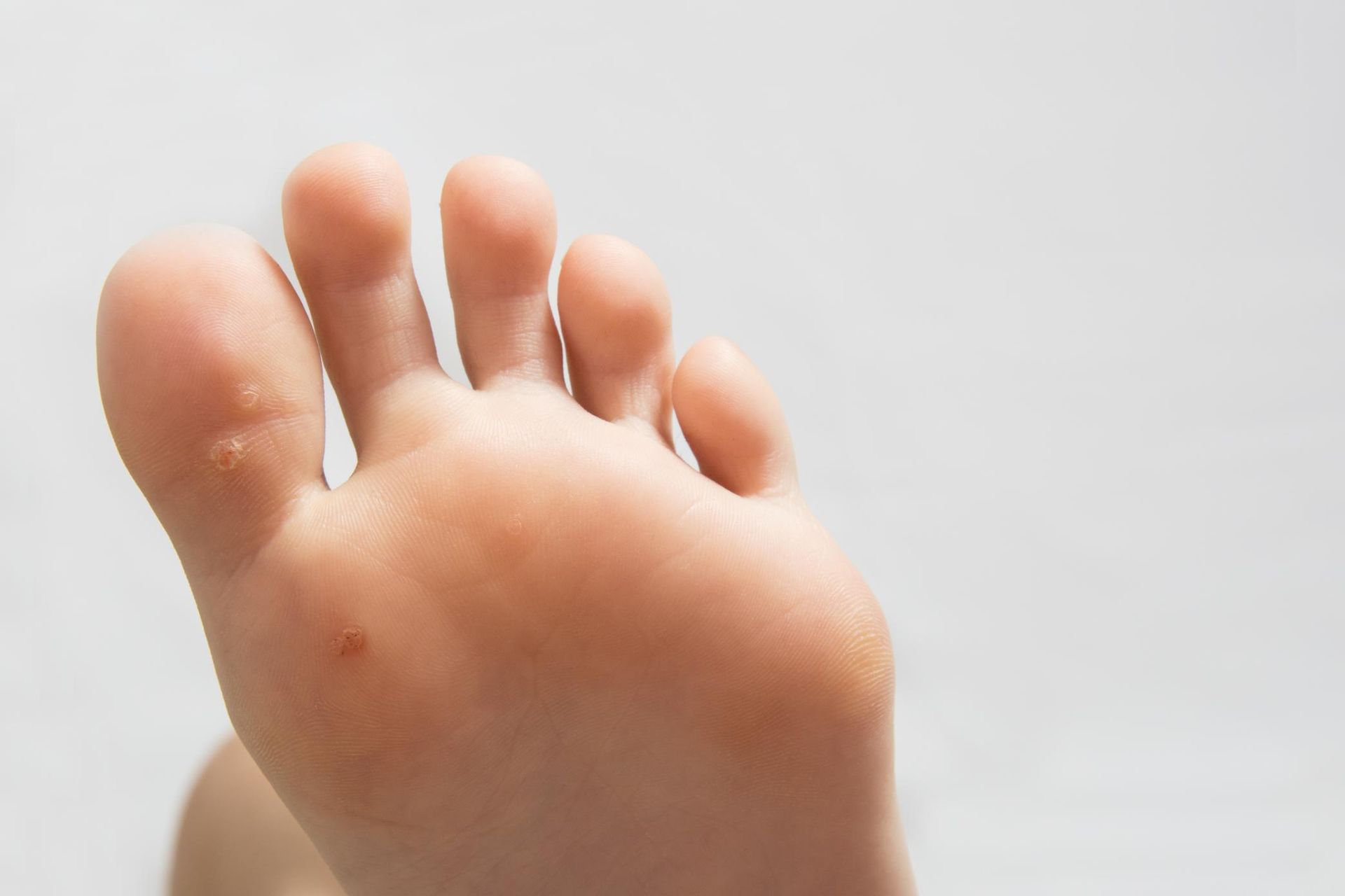 Planta de un pie con dos pequeñas verrugas, sobre un fondo gris claro.