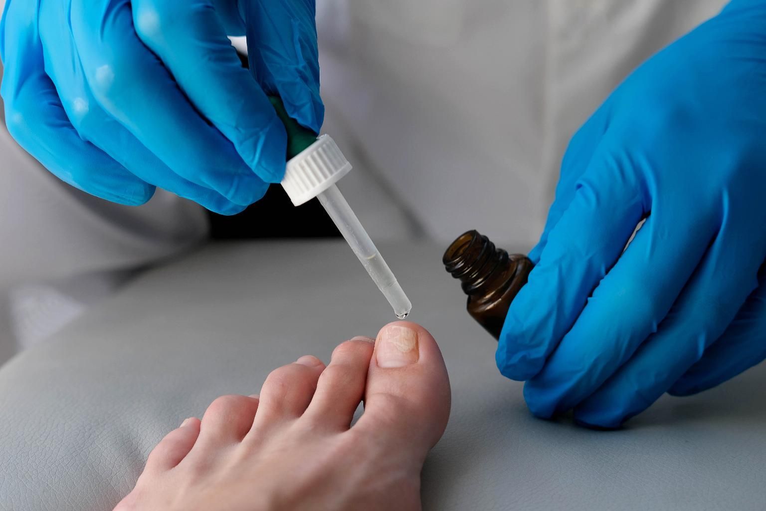 Persona aplicando líquido en una uña del pie con un gotero, usando guantes azules.